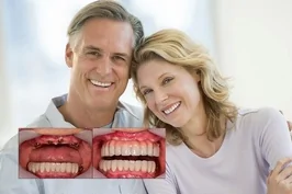 Зубы за 1 день - трансформация улыбки