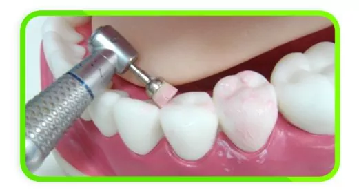 Полировка зубов процедура профессиональной гигиены