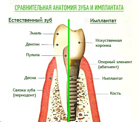 сравнение зуба и имплантата