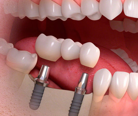 Как Выглядят Импланты Зубов Фото