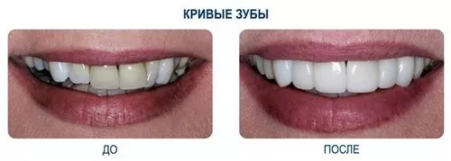 устранение кривизны зубов с помощью люминиров