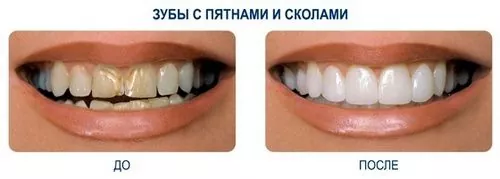 люминиры устраняют сколы и кривизну зубов